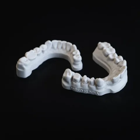 Dental models with spaces where teeth are missing