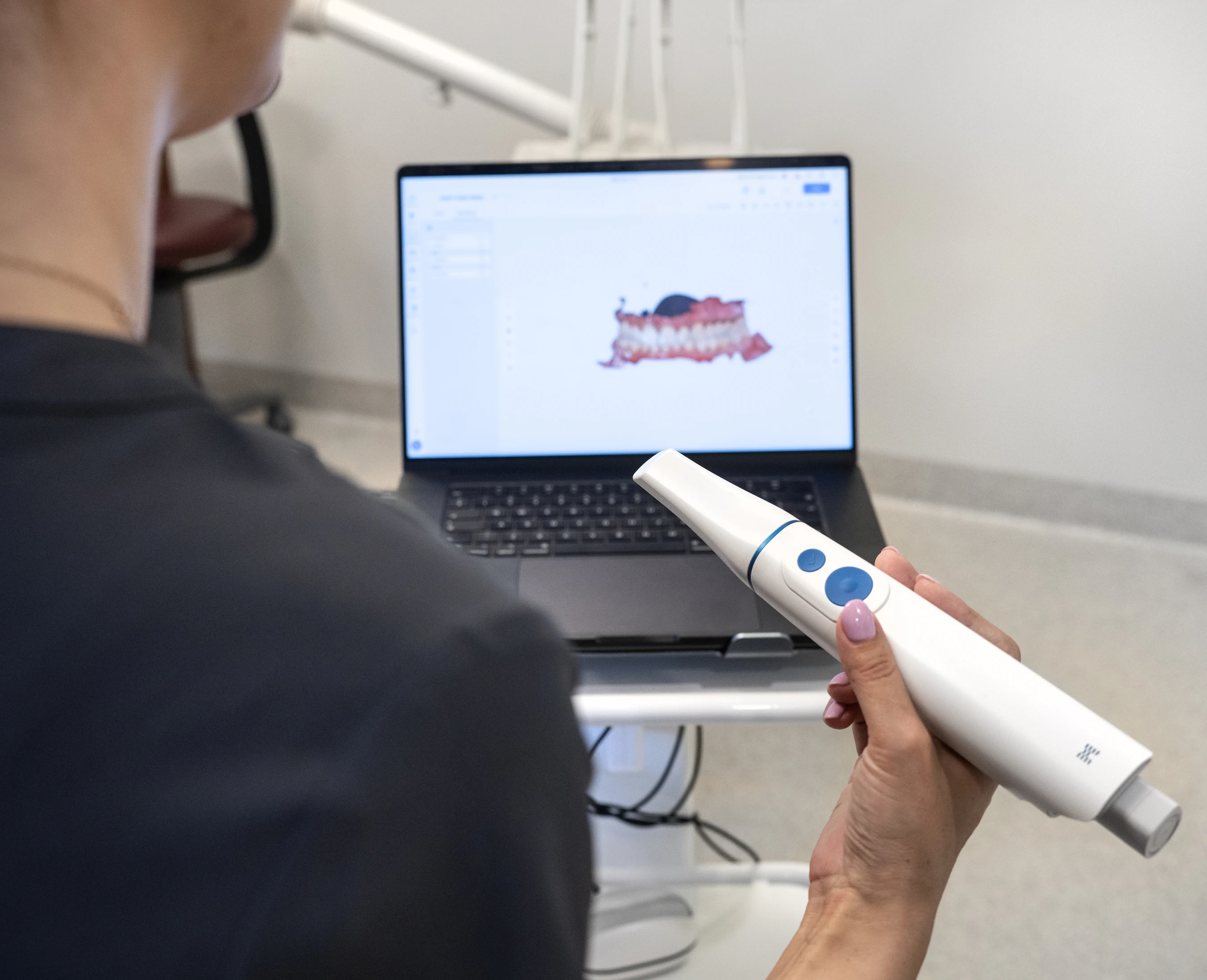Intraoral scanner and a digital view of the mouth