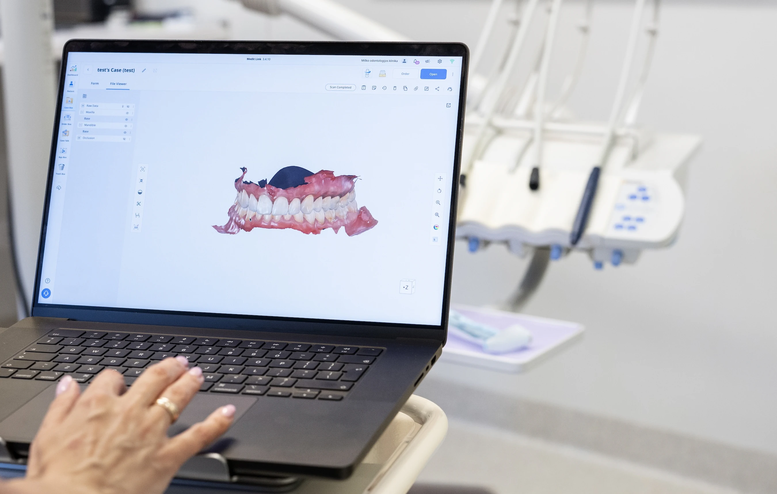 Digital bite model in dental software